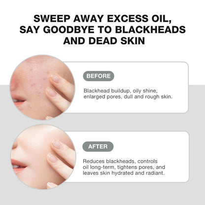 SKINEVER Salicylic Acid Mud Mask – Deep Cleansing & Oil Control Mask for Pores UAE