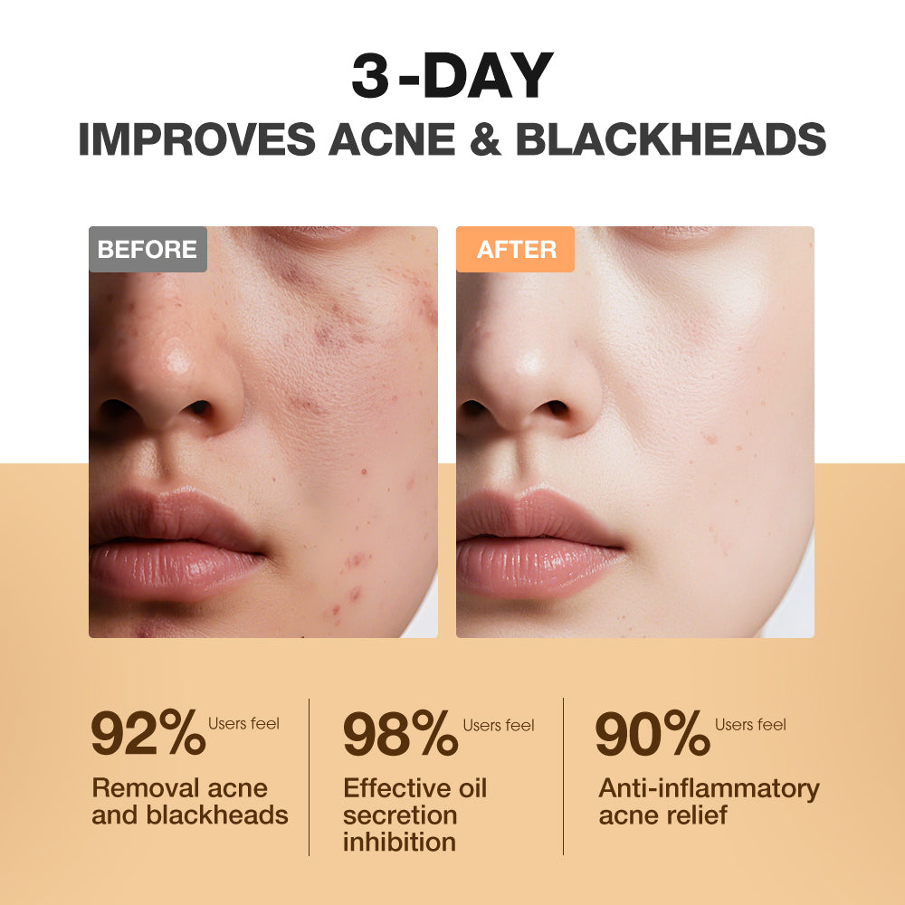 SKINEVER Salicylic Acid Refreshing Acne Skin Pads – Anti-Acne & Oil Control Pads for Clear Skin UAE